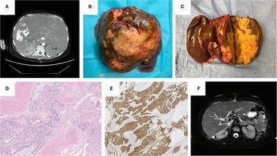 Liver Transplantation for Unresectable Calcifying Nested Stromal Epithelial Tumor: Case Report With a 1-Year Follow-Up and Review of Literature